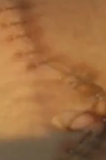 Suite: Double Nephrectomy poster